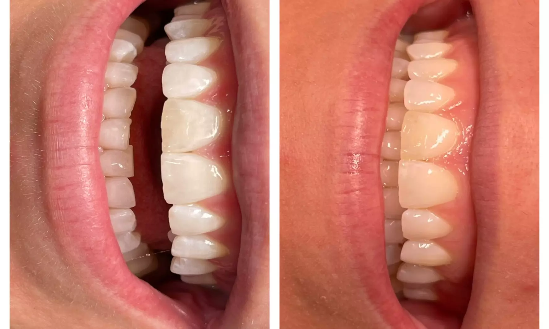 Discover Skinful beauty's teeth whitening options for one or two sessions with up to 50% off, enhancing your smile's brilliance - Second Medium