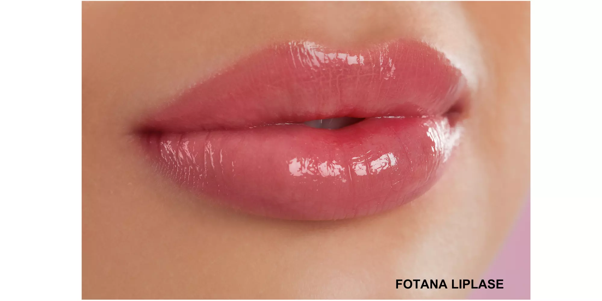 Revitalize Lips with One or Three Fotona LipLase Treatments at Bio Med Spa  (Up to 52% Off) - Second Medium