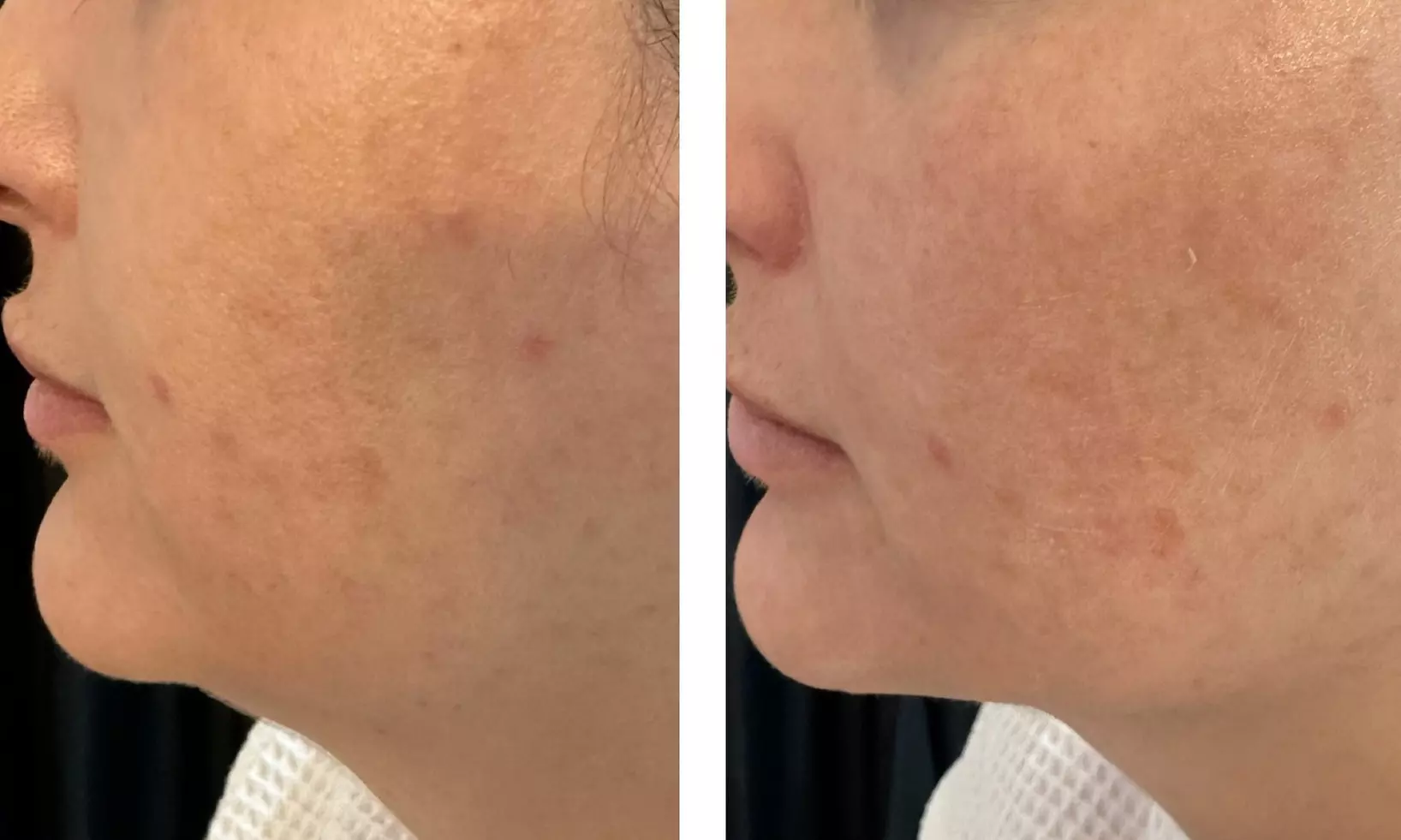 Up to 65% Off on Facelift - Non-Surgical at Velvet Vanity By Puja