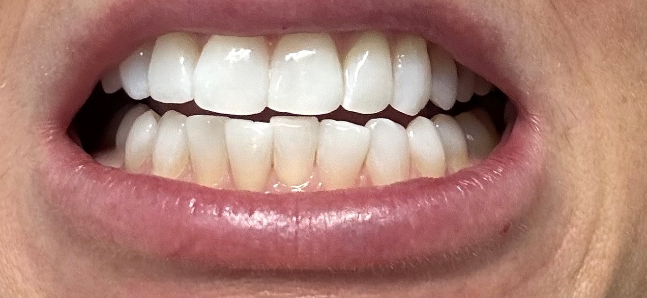 Up to 55% Off on Teeth Whitening - In-Office - Non-Branded at Bright Smiles