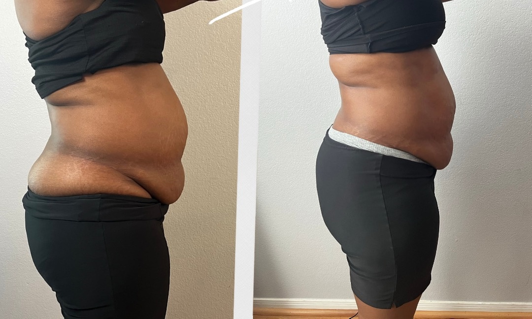 Up to 67% Off on Ultrasonic Fat Reduction at BeUtiful Bae Contouring