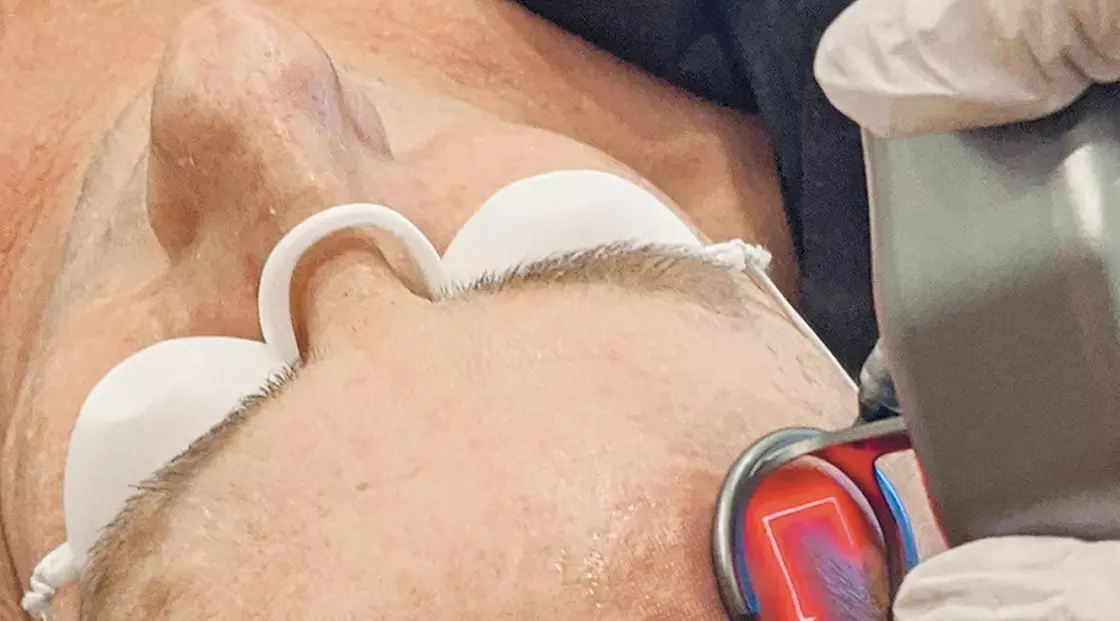 Up to 50% Off on Facial - Thermal Rejuvenation at UK Aesthetics Lounge