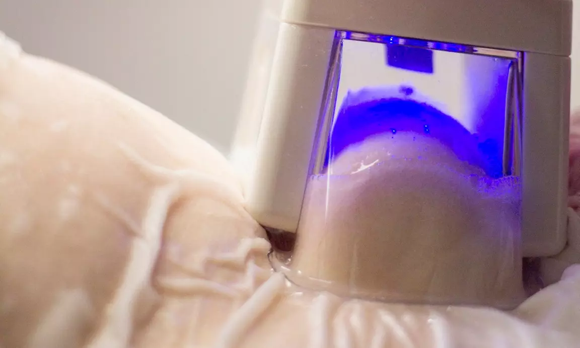 Redukcja tkanki tłuszczowej z kriolipolizą na wybraną partię ciała