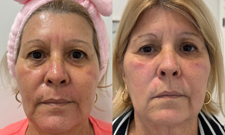 Image 3: Revitalize with 1 or 3 Non-Surgical Facelift and Anti-Aging Treatment