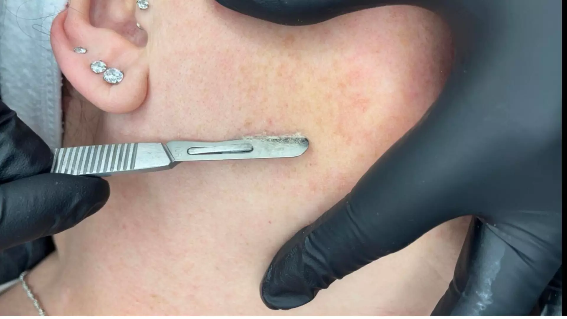 Up to 50% Off on HydraFacial at Summer Kinsey Aesthetics - Second Medium