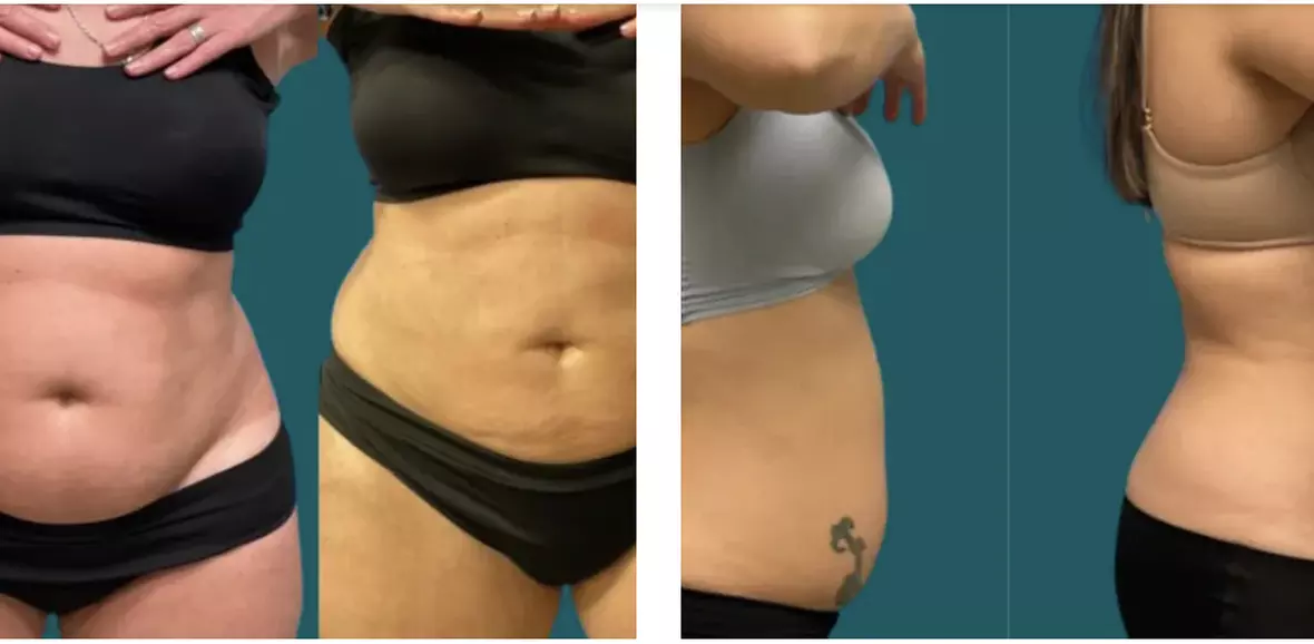 Experience body transformation at Diamond Beauty Bar Orlando with sessions of cavitation, wood therapy, and more, up to 50% - Primary Image