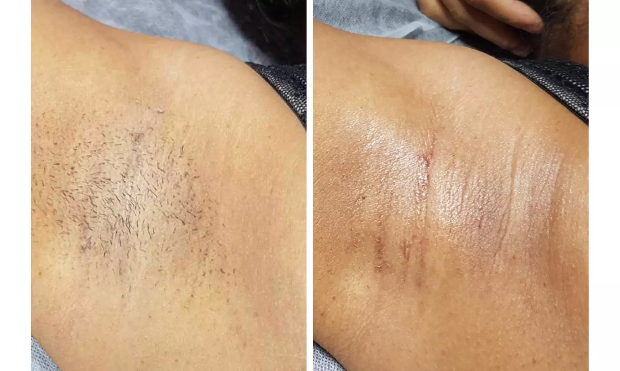 Up to 20% Off on Waxing - Underarm at Smooth Waxing Studio - Primary Image