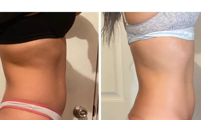 Up to 75% Off on Cavitation at Pretty Lyfe Esthetics