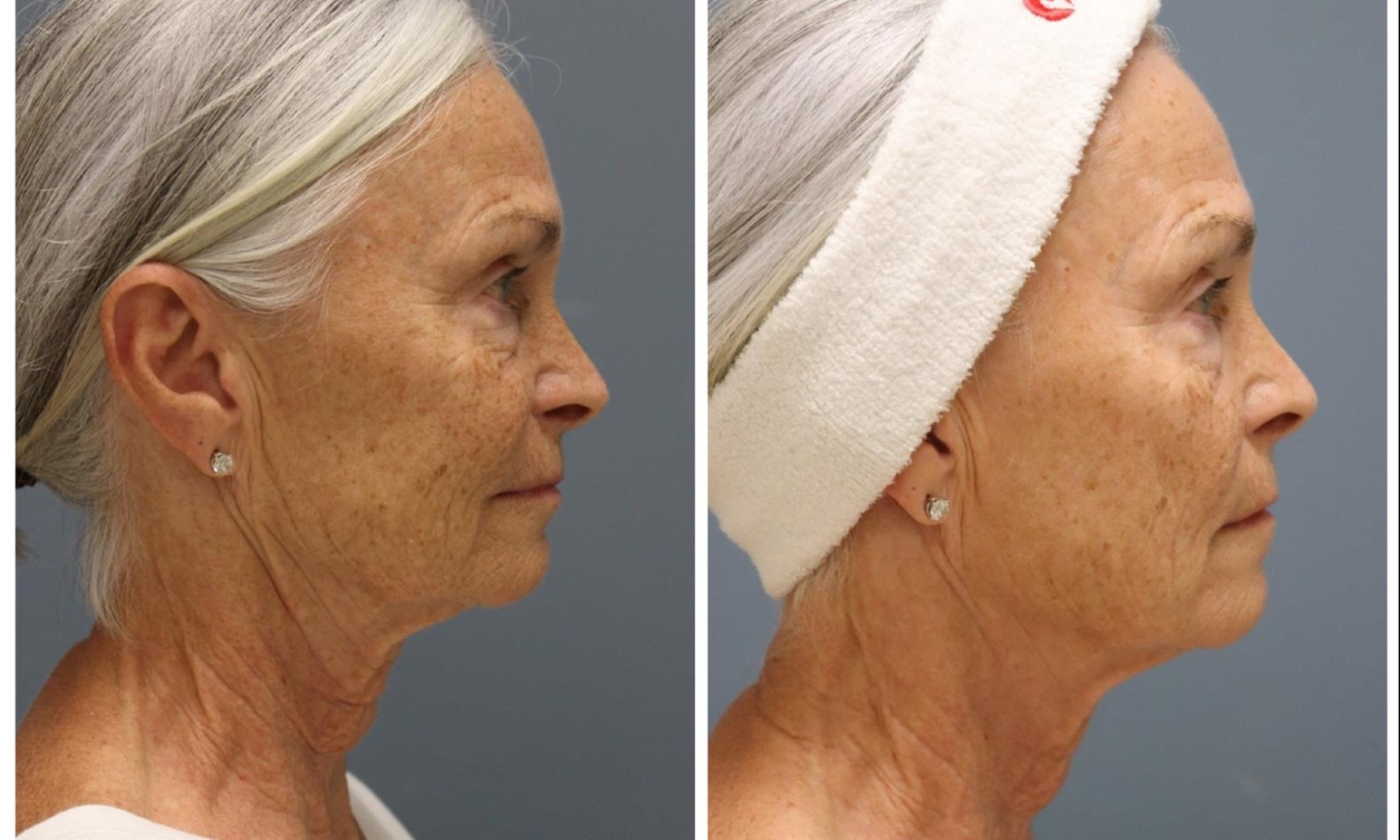 Transform Your Skin: RF Microneedling for Face & Neck