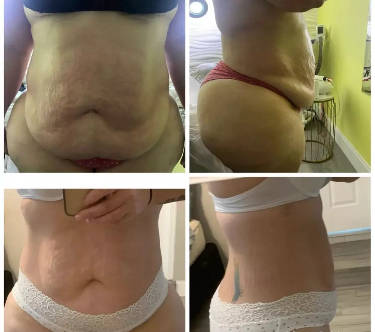 Up to 30% Off on Ultrasonic Fat Reduction at M Gold Beauty Spa