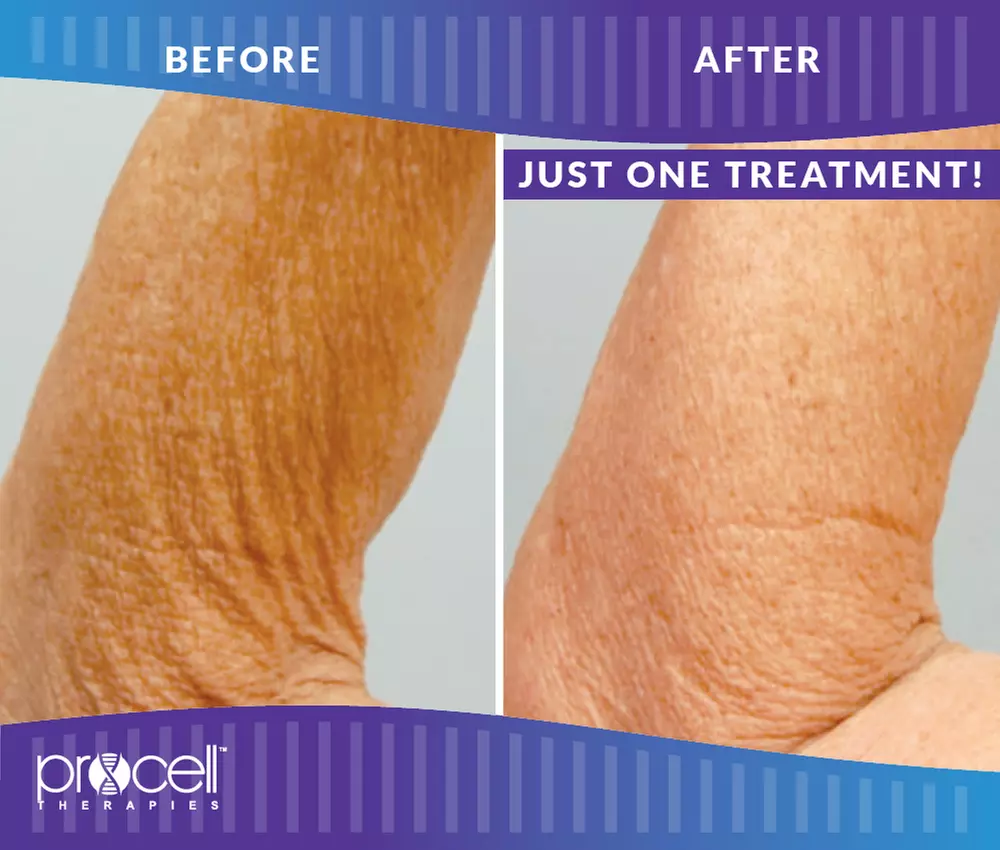 Up to 55% Off on Micro-Needling at Highland Salon and Medi Spa - Second Medium