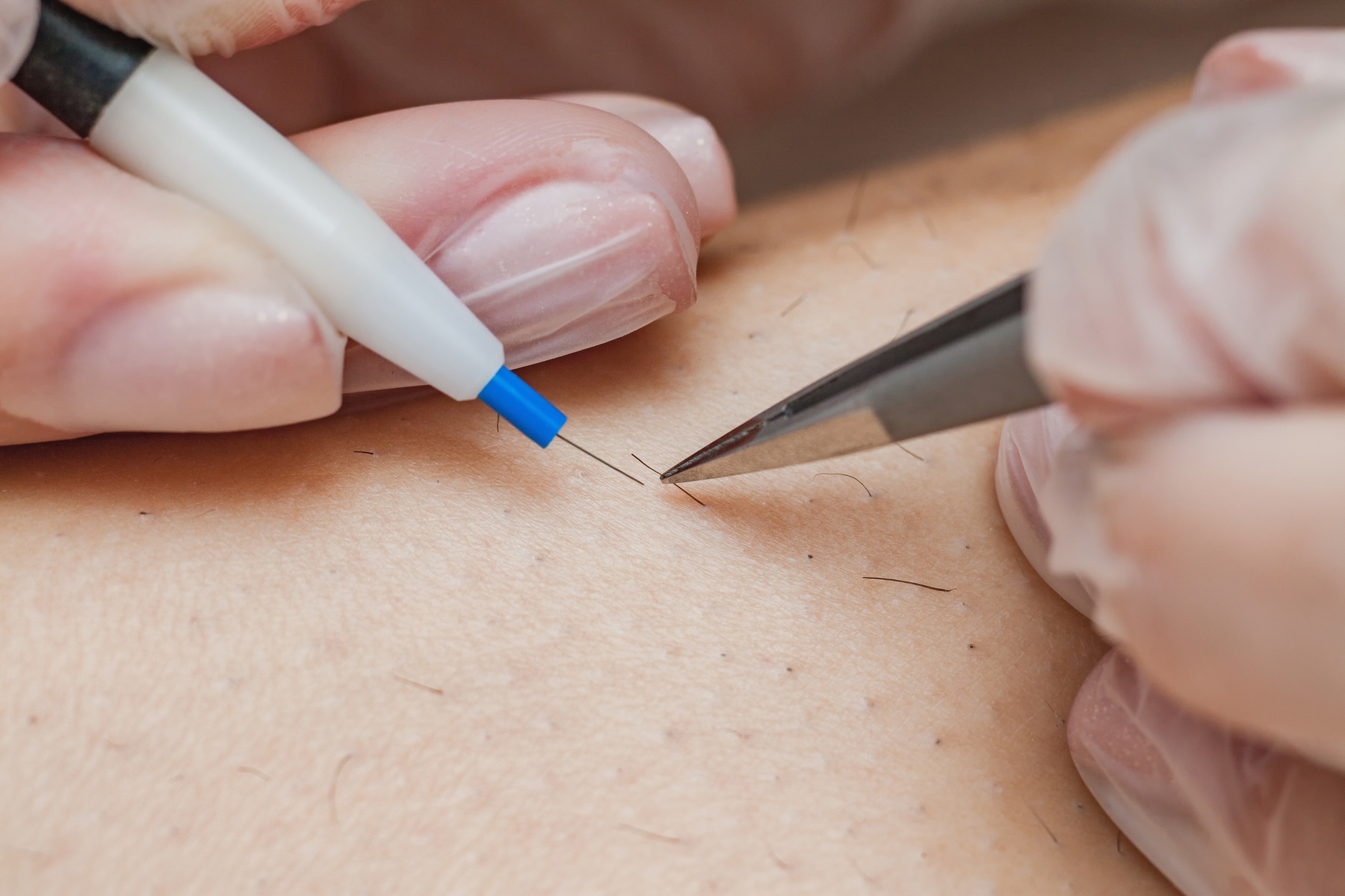 Up to 30% Off on Electrolysis at MOON ELECTROLYSIS