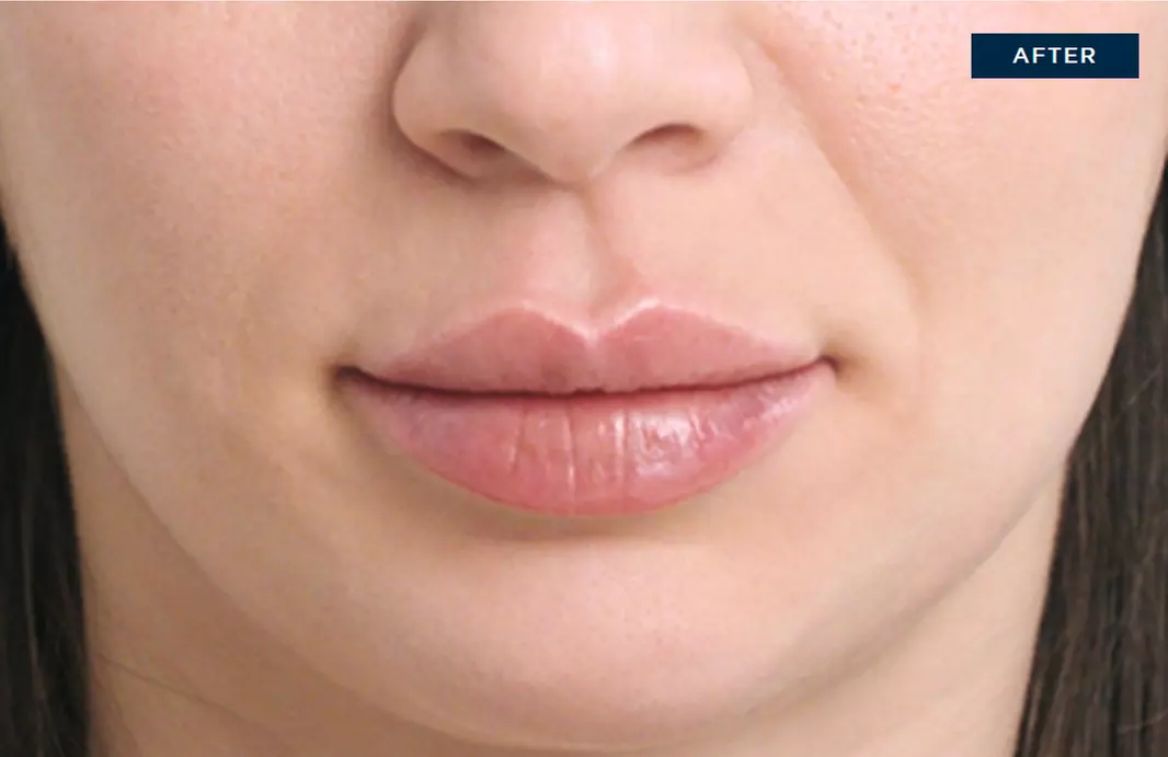 Up to 35% Off on Injection - Dermal Filler at MediMorph