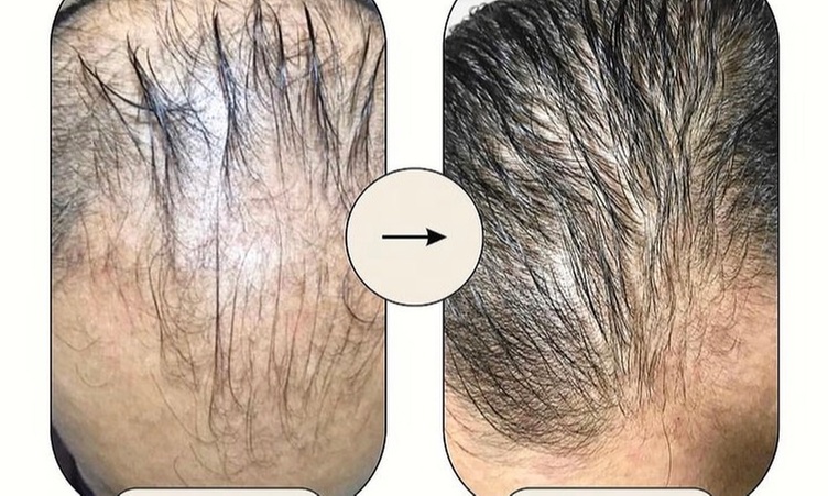 Hair Restoration - Non-Surgical at Vistoso Medical Spa