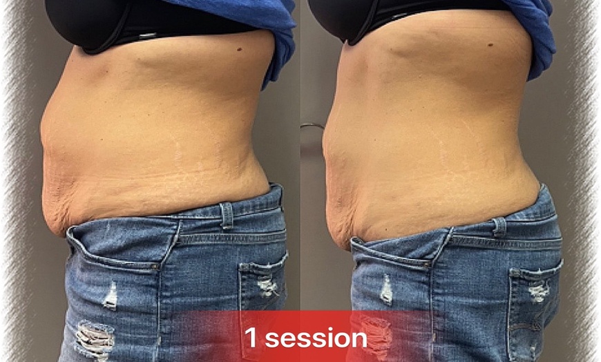 Image 1: Integusculpt RF Skin Tightening & Cavitation Treatment