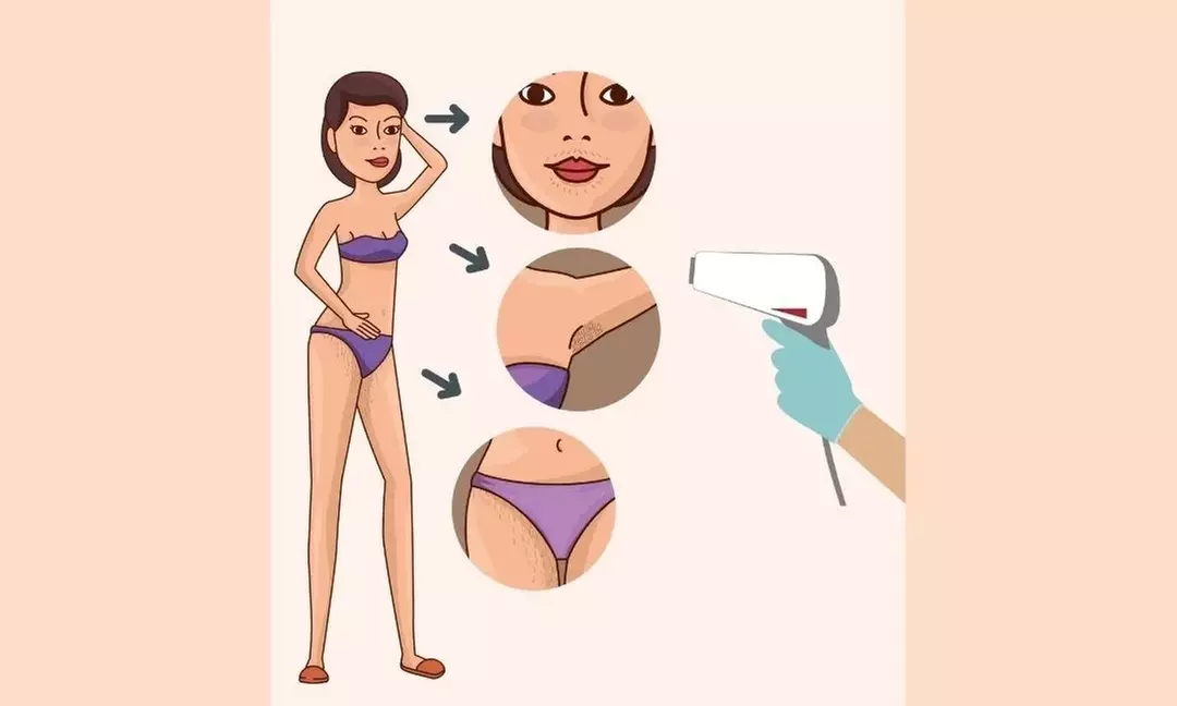 Up to 50% Off on Laser Hair Removal at dé Beauty Spa - Second Medium