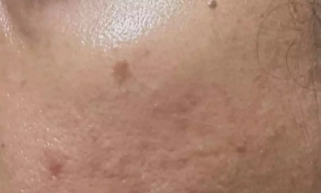 Revitalize Your Skin with Acne Treatment at kate beauty studio (Up to 40% Off) - Second Medium