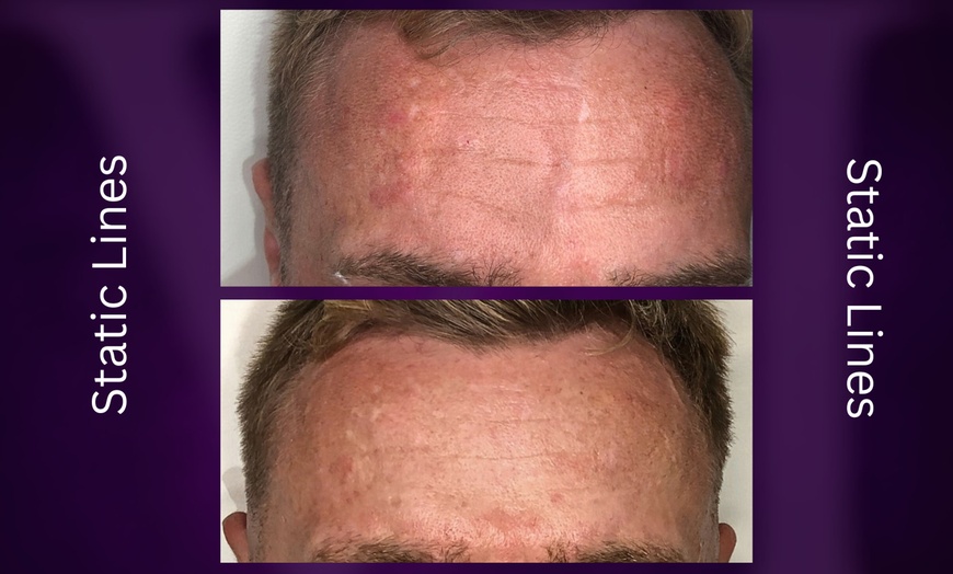 Image 5: Azzalure Skin Booster for Target Frown, Forehead & Eye Wrinkles 