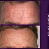 Image 5: Azzalure Skin Booster for Target Frown, Forehead & Eye Wrinkles 