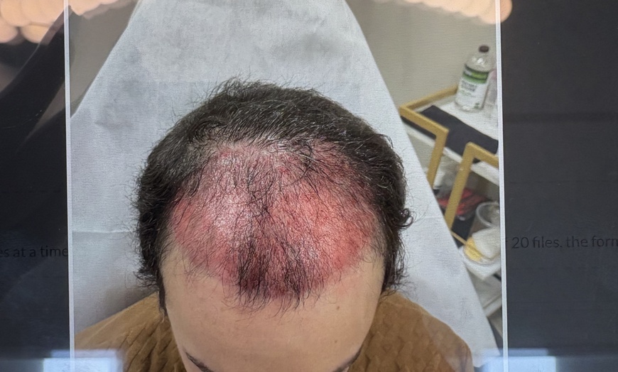 Image 4: Up to 59% Off on Hair Restoration - Non-Surgical at VC Esthetics