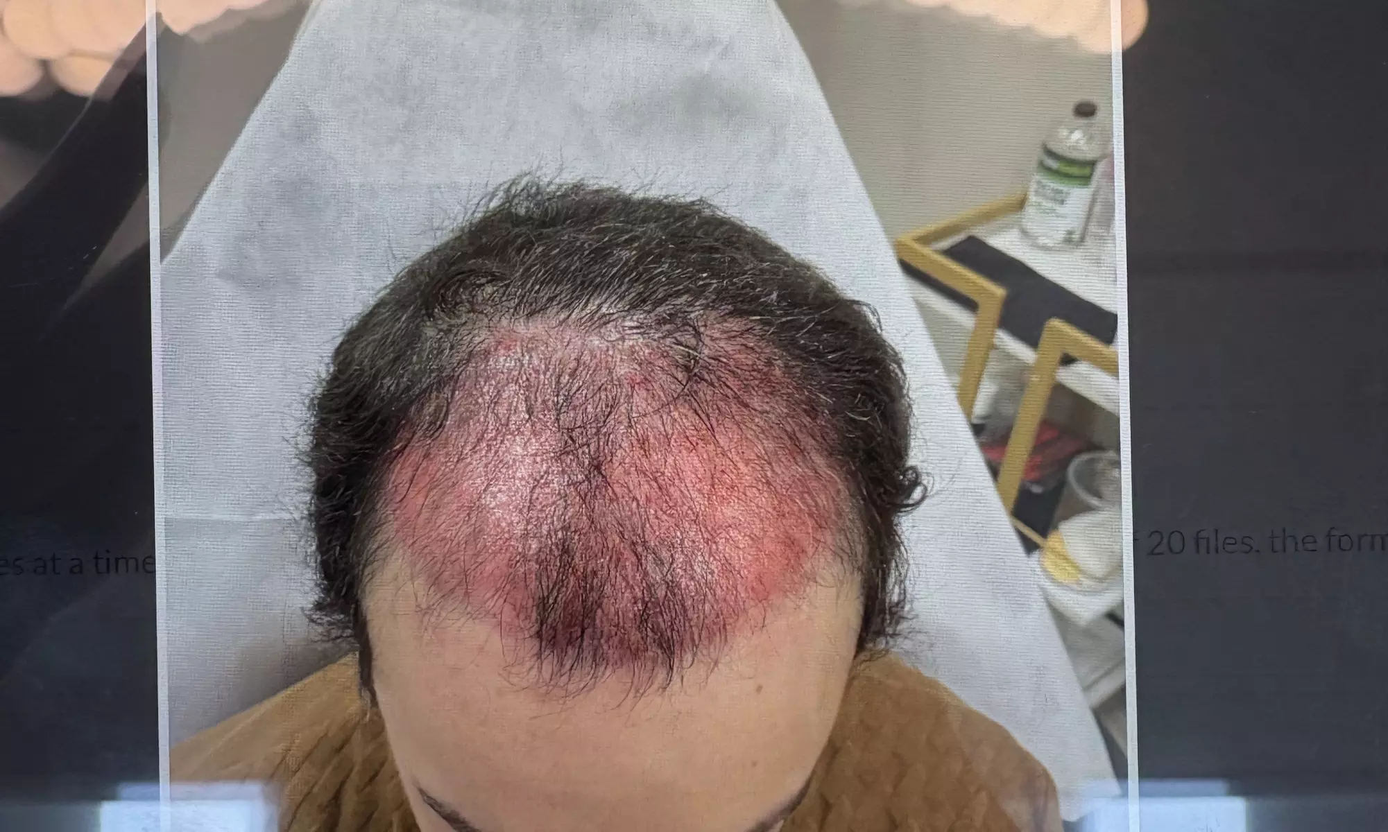 Up to 59% Off on Hair Restoration - Non-Surgical at VC Esthetics