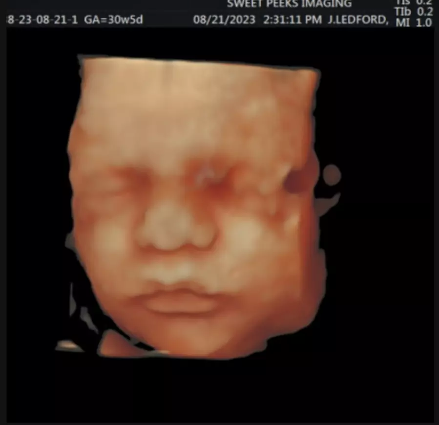 Up to 43% Off on Ultrasound - 3D / 4D at Sweet Peeks Imaging - 3D/4D Ultrasound - Primary Image