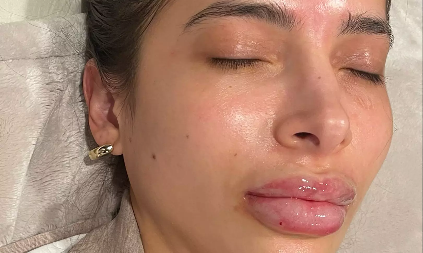 Juvederm & Sculptra Glow-Up Bundle for Ultimate Facial Volume