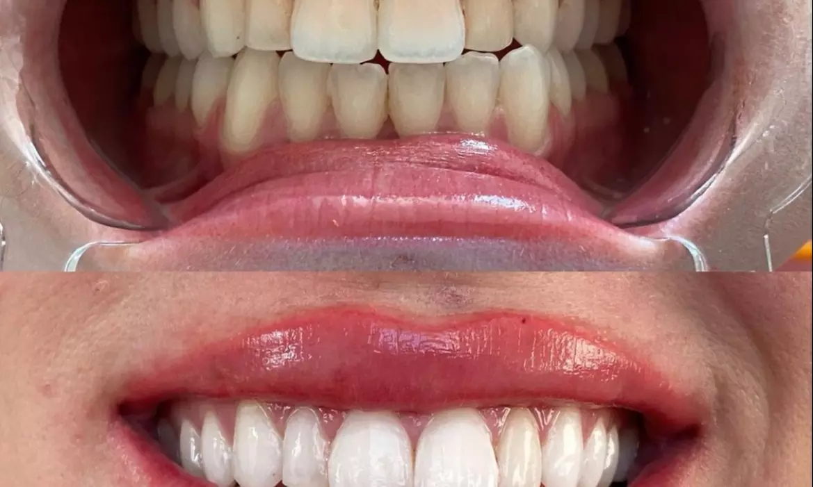 Experience Emira's dental grade teeth whitening for a radiant smile, with up to 50% off! - Second Medium