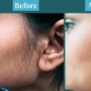 Image 4: Laser Hair Removal: Six Treatments for Various Areas