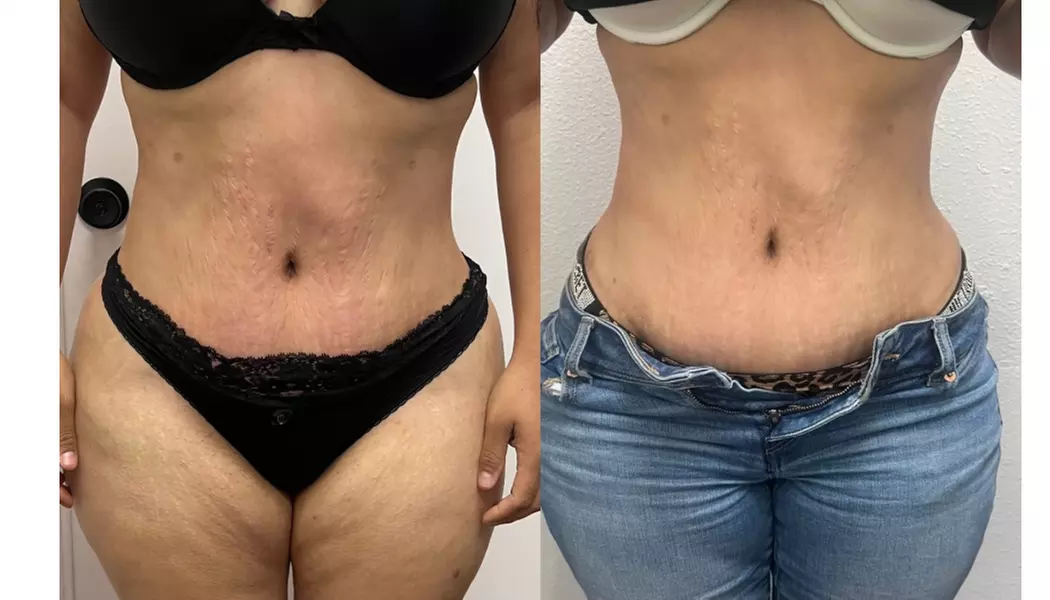 Up to 47% Off on Fat Reduction - Non-Branded at The pigment bar - Primary Image