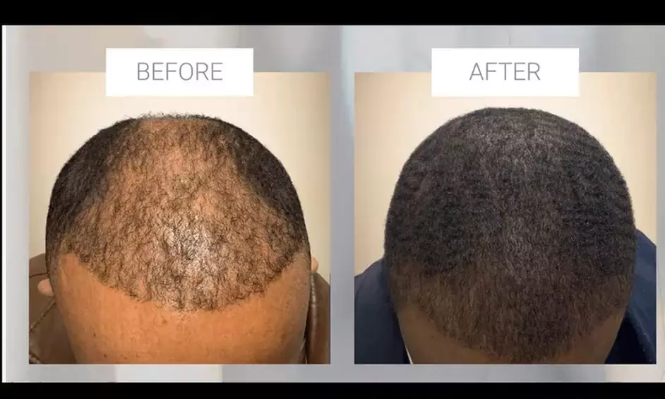 Rejuvenate with PRP Hair Restoration Treatment or Facial Injections