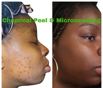 Medical grade peel: a blend of peels for hyperpigmentation/acne for ALL skin types - Restorative Med Spa NYC