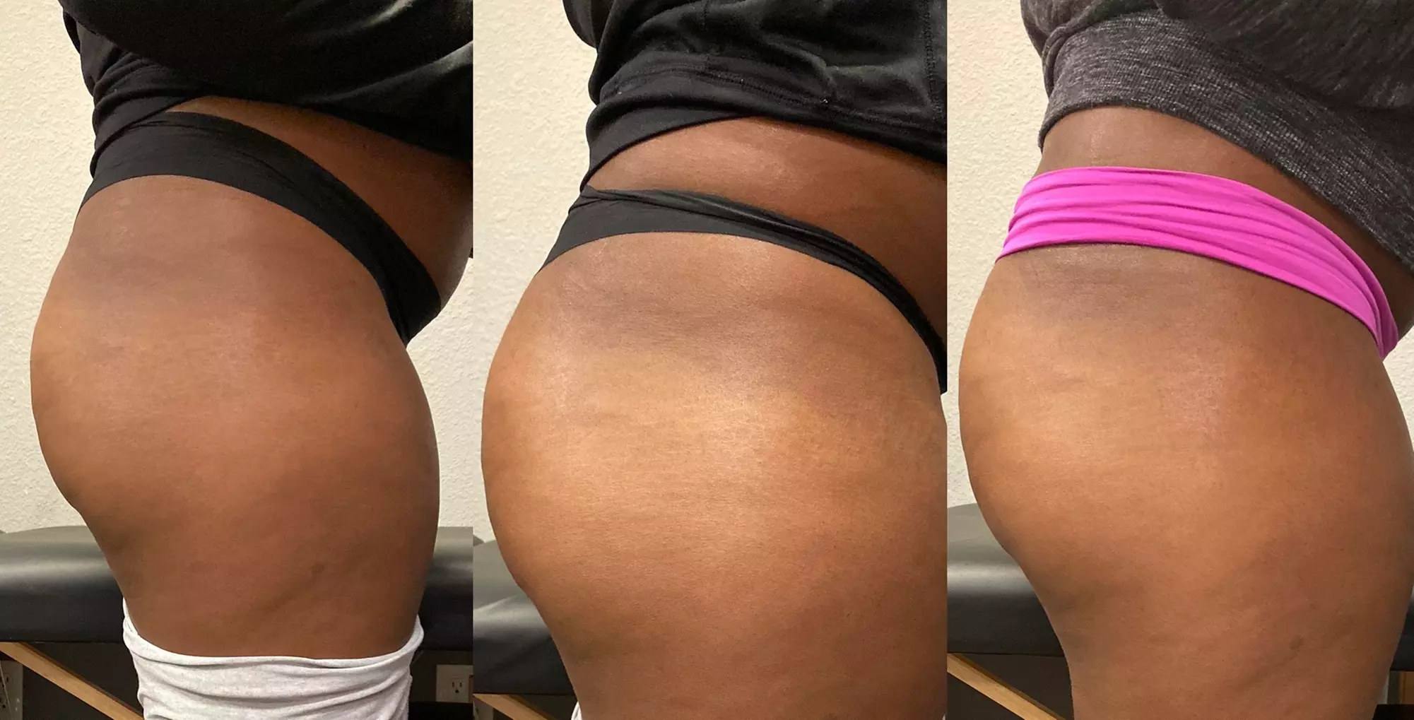 Non-Surgical Butt Lift Sessions for a Firmer Silhouette