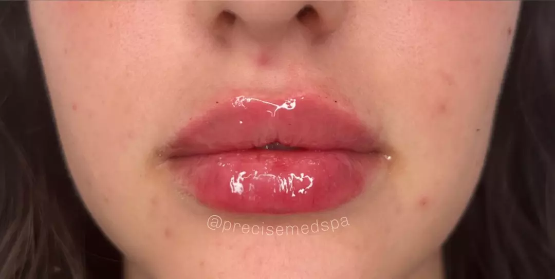 Plump & Hydrate Lips with Restylane Kysse Lip Filler Treatment