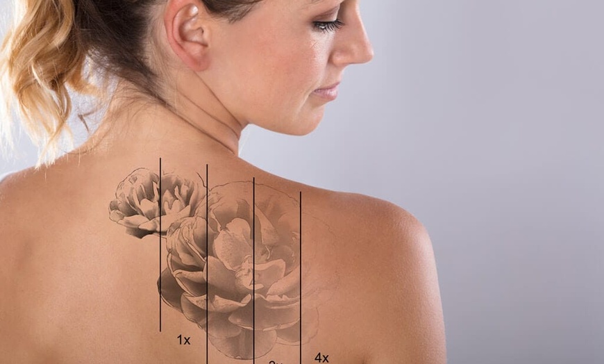 Image 3: 1 or 2 Sessions of Laser Tattoo Removal on Area Up to 5cm and More