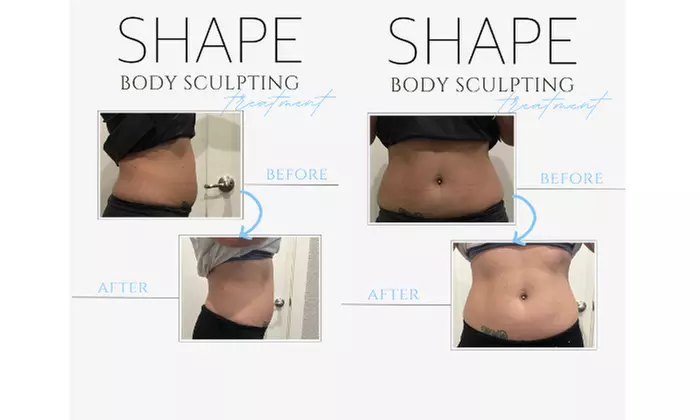 Get $1000 Off 10 Body Sculpting Treatments Package Now