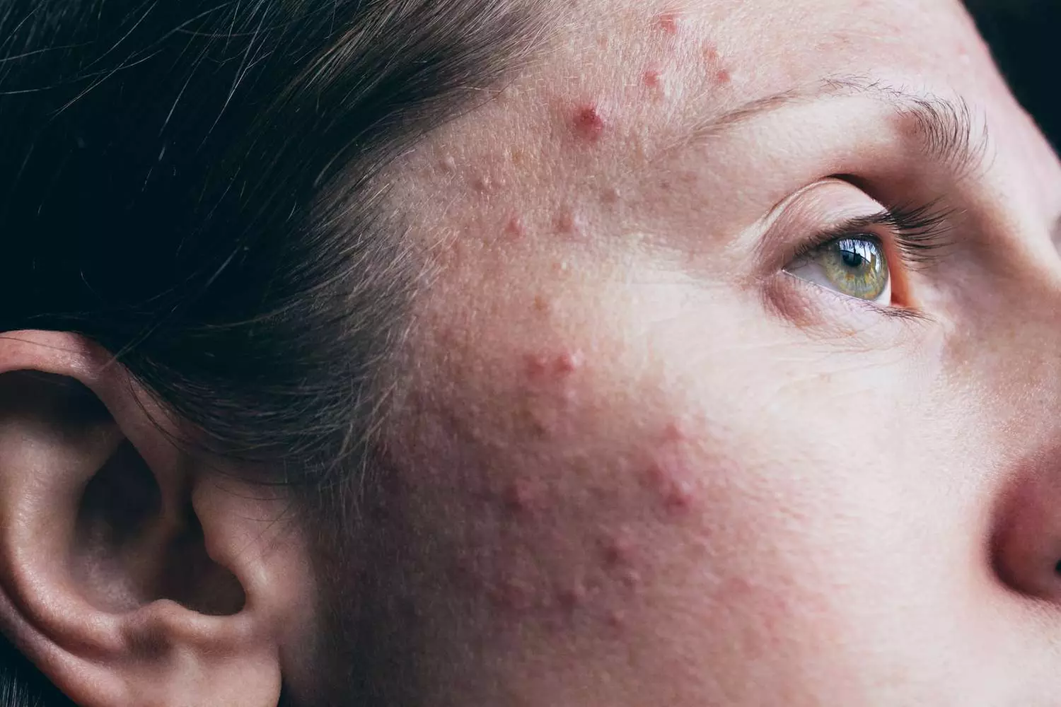 Discover Chrysalis Wellness Spa's effective acne treatments with up to 30% off and smooth, radiant skin guaranteed - Primary Image