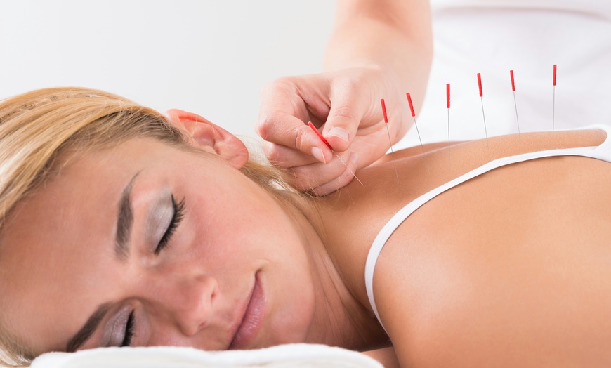 Image 1: Acupuncture Session with Massage at Health