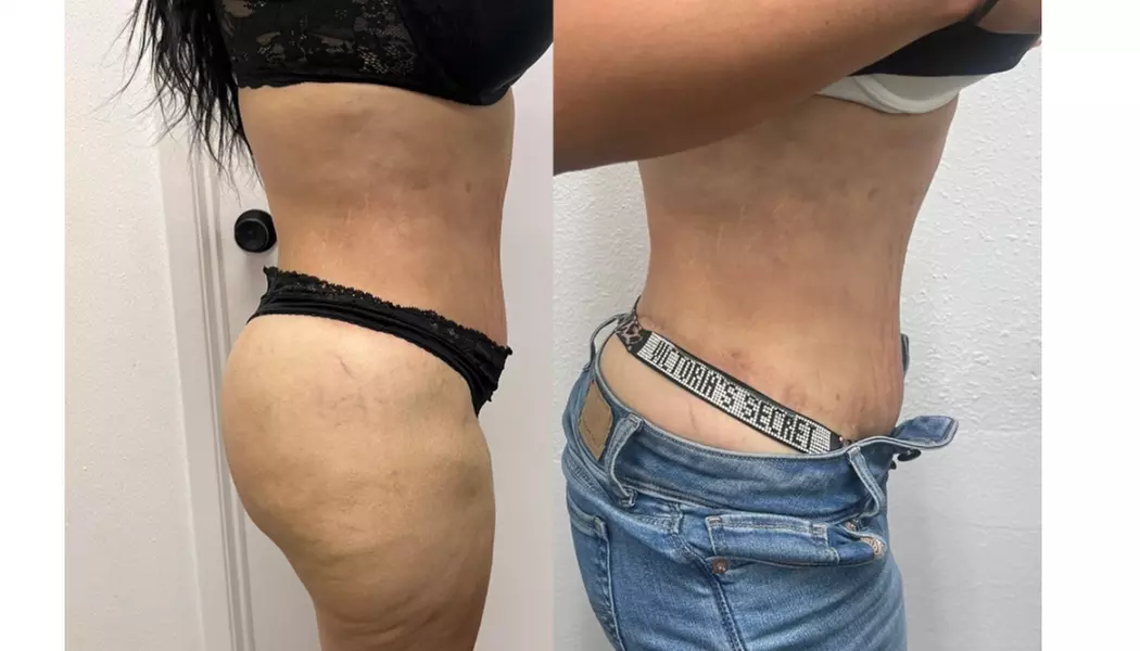 Up to 47% Off on Fat Reduction - Non-Branded at The pigment bar - Second Medium