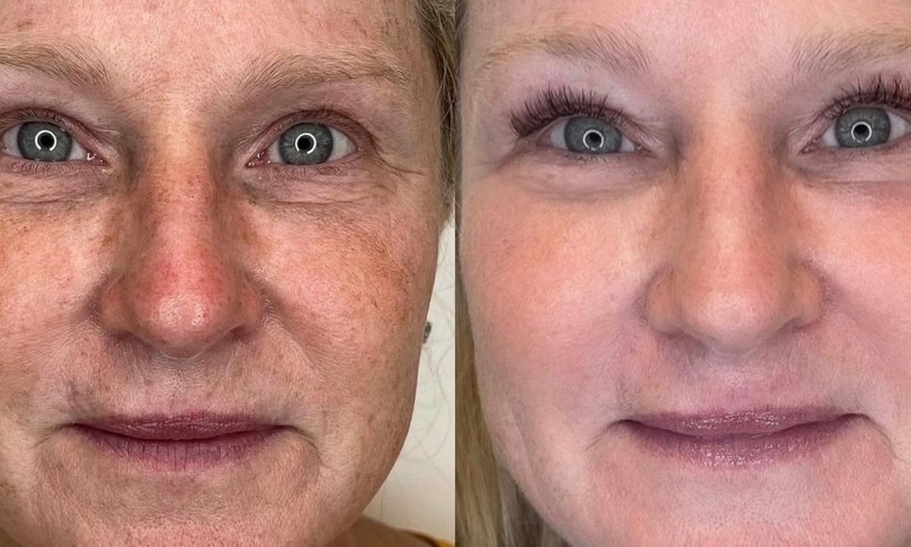 One Fibroblast Plasma Session on One Small, Medium, Large, Extra Large Area or for Hands ( Up to 56% Off ) - Second Medium