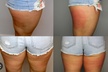 Up to 72% Off on Fat Reduction - Non-Branded at The Covery Fruitville - Second Medium