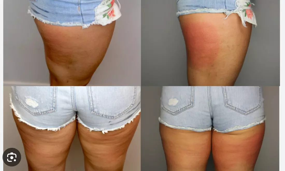 Up to 75% Off on Fat Reduction - Non-Branded at The Covery Fruitville
