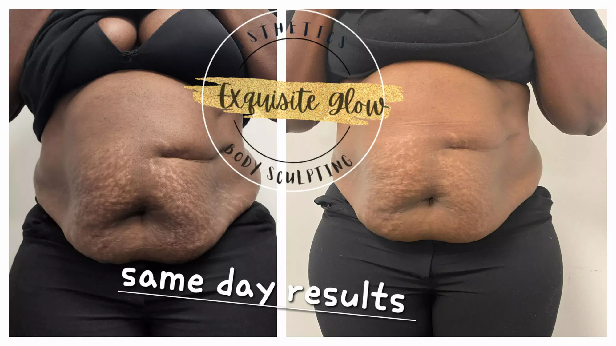 Transform your silhouette with Exquisite Glow SC's 360 snatch stomach service, offering non-invasive fat reduction and skin tightening up to 48% - Primary Image