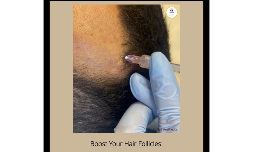 Image 1: Up to 25% Off on Micro-Needling at Étoilée aesthetics