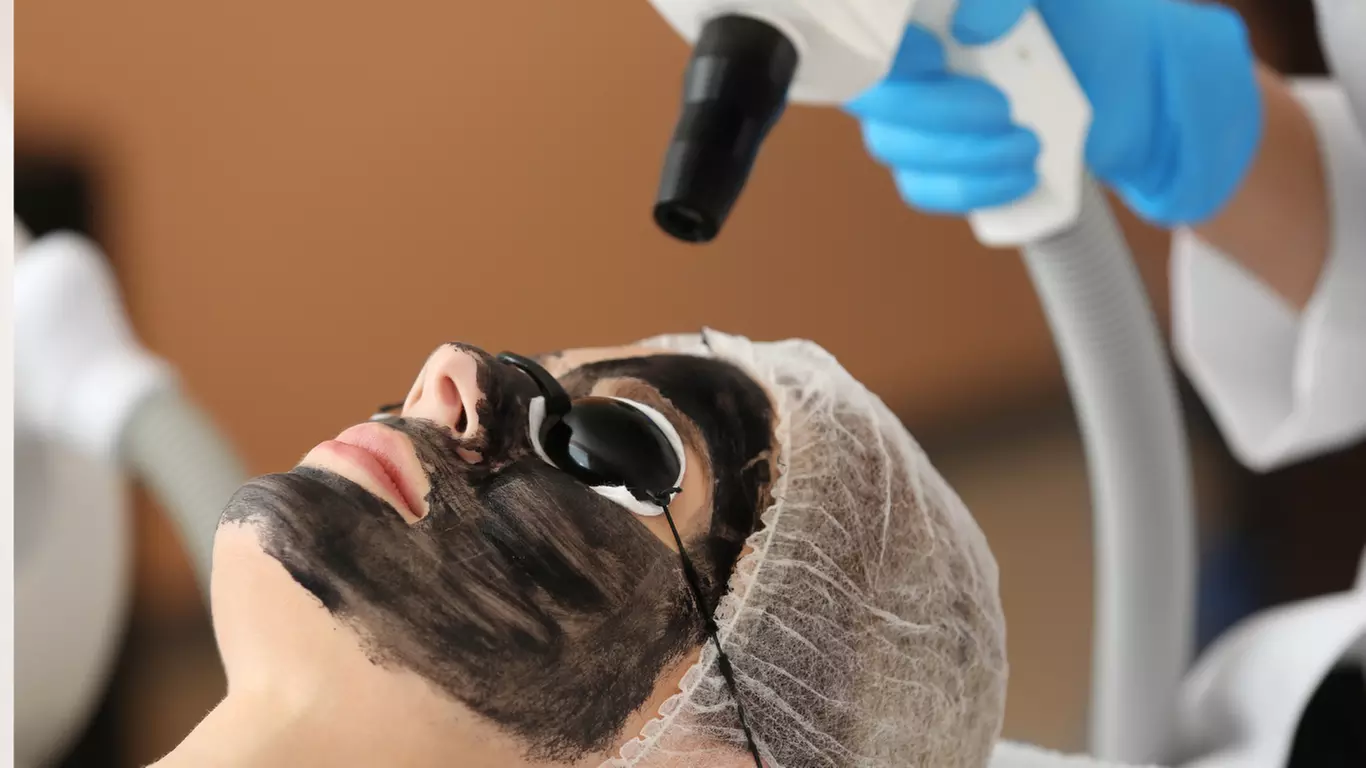 Experience the Facial Carbon Peel at Lasser4u, enjoy radiant skin up to 51% off with one revitalizing session - Primary Image