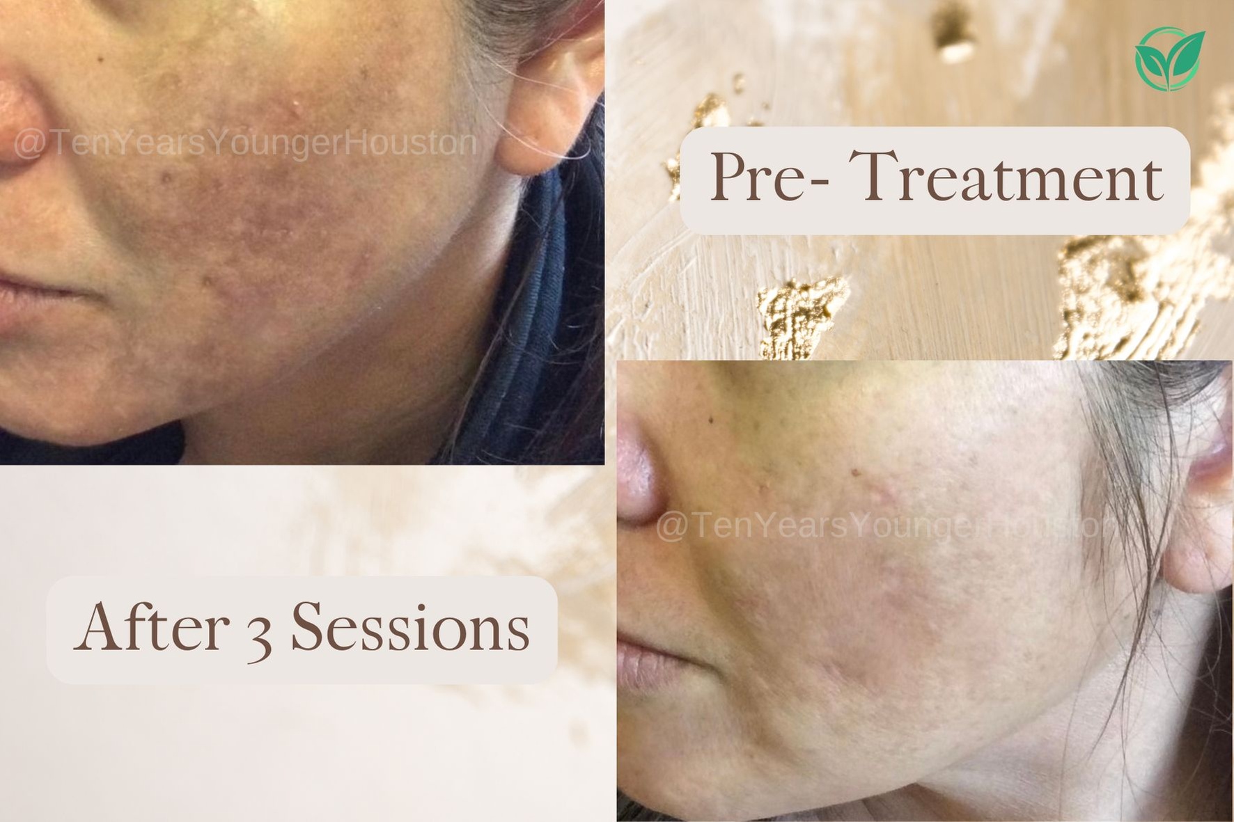 Experience Microneedling with PRP for Skin Rejuvenation