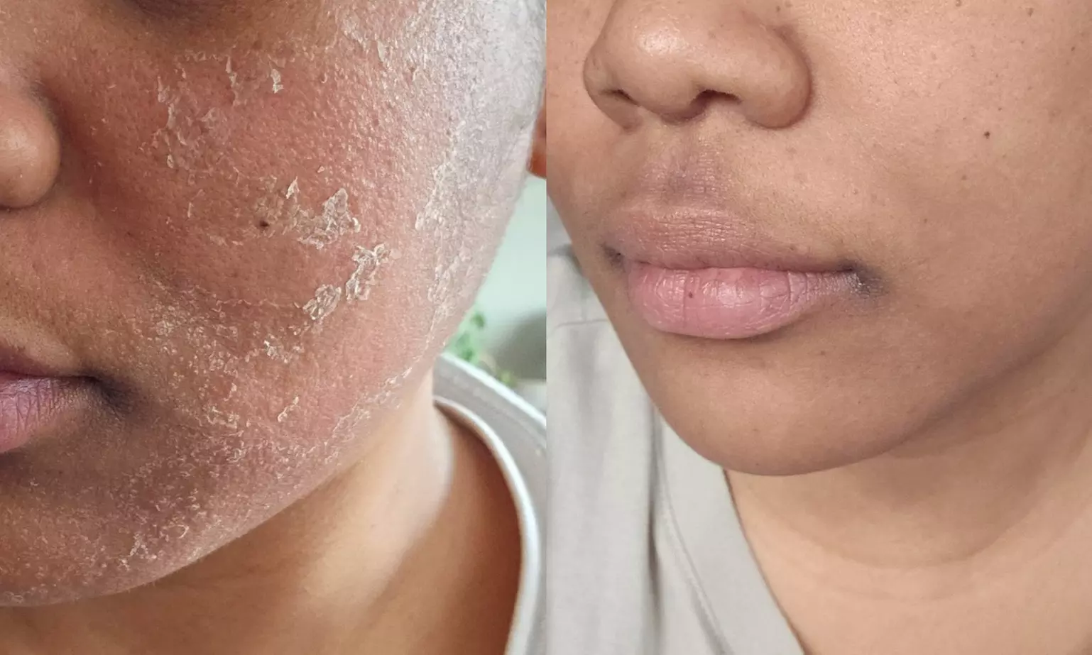 Up to 58% Off on Green peel - Primary Image