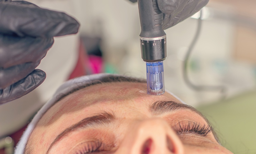 Image 6: Kosmetisches Microneedling und Diamant-Mikrodermabrasion für 1 Person