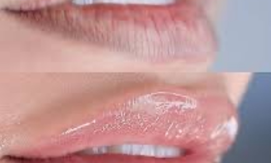 Image 2: Two or Three Hydrogloss Lip Treatments at T Body Contour
