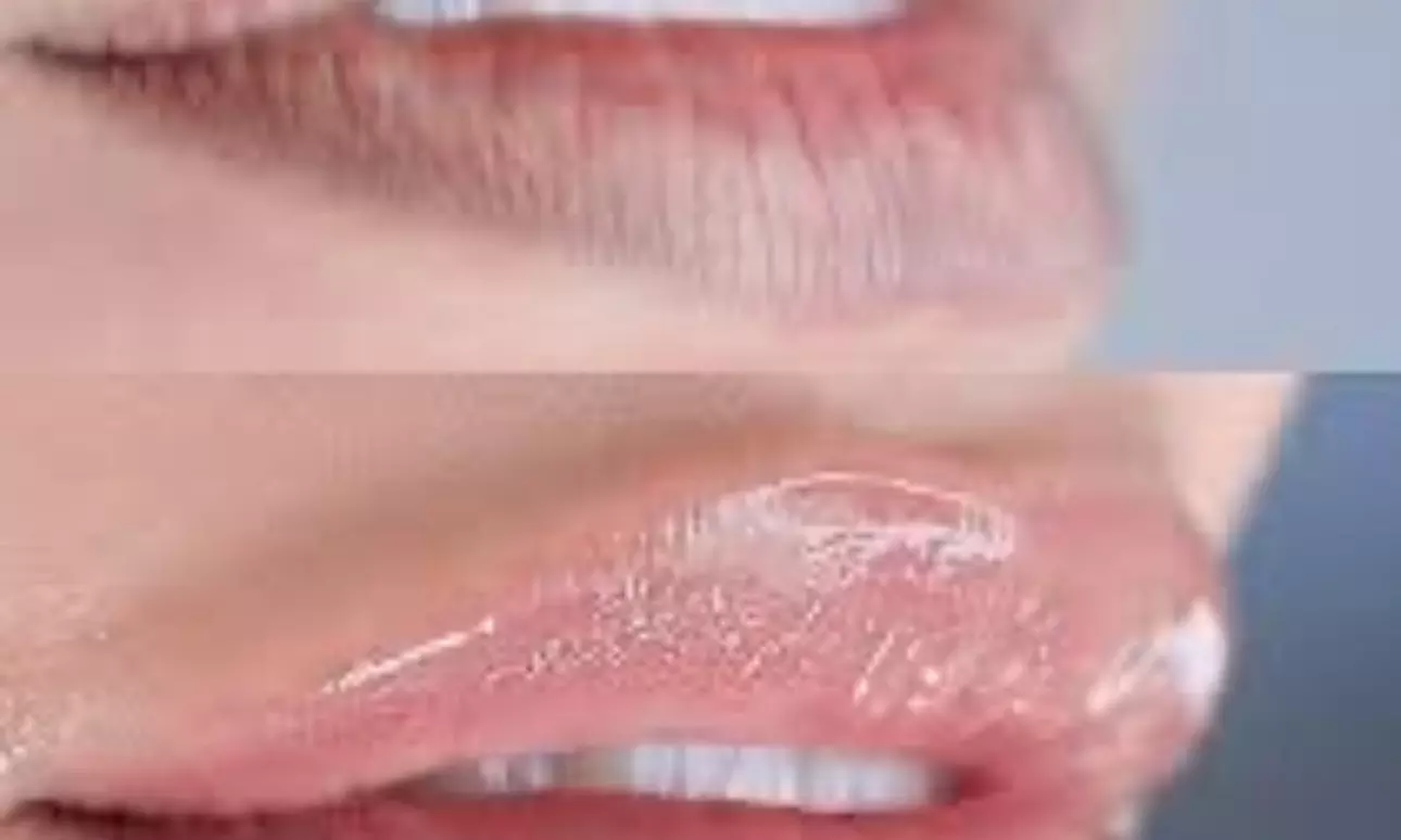 Two or Three Hydrogloss Lip Treatments at T Body Contour